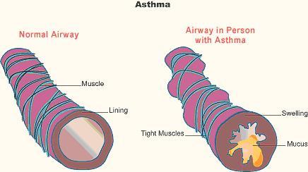 Asthama