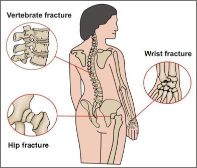 Osteoporosis