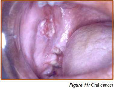 Oral Cancer.png