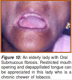 Oral Submucous Fibrosis.png