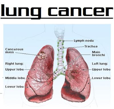 lung cancer.jpg