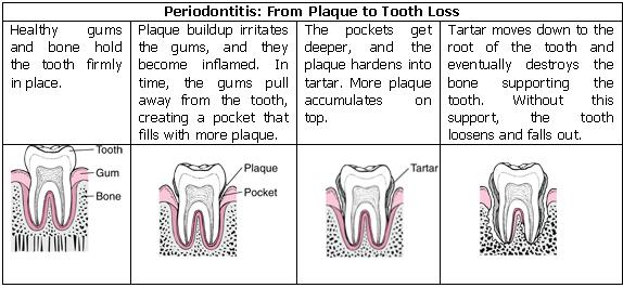 Periodontitis