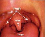 Tonsils3
