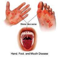 Hand, Foot and Mouth Disease — Vikaspedia