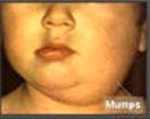 Mumps