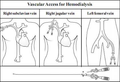 Dialysis — Vikaspedia