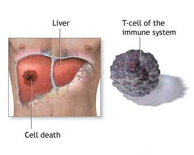 Ameoebic liver