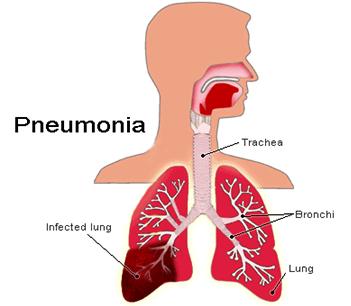 Pneumonia1