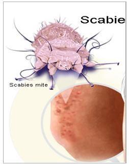 https://static.vikaspedia.in/media/images_en/health/diseases/skin-diseases/scabies-1test.jpg