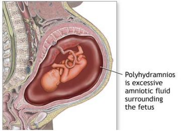 Hydramnios