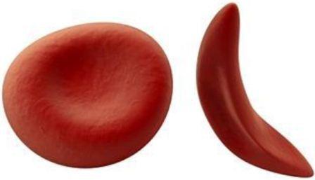 Sickle Cell1