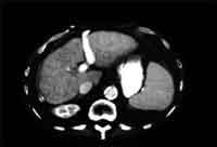 Liver cirrhosis- CT scan.jpg